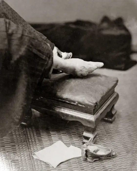 Framed Print : Bound foot, China, circa 1880s Framed Print : Bound foot, China, circa 1880s
