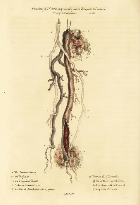 Framed Print : Claude Pouteau's doctrine of tying nerves to arteries in amputat Framed Print : Claude Pouteau's doctrine of tying nerves to arteries in amputat