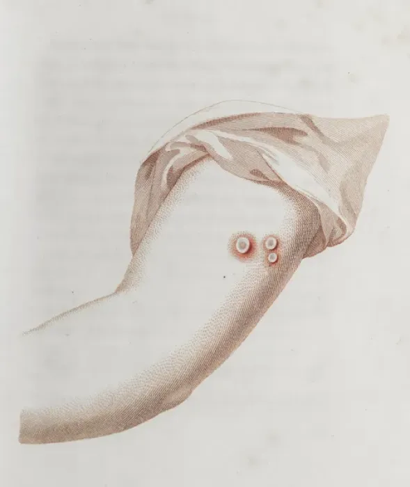 Framed Print : Coloured depiction of lesion on arm Framed Print : Coloured depiction of lesion on arm