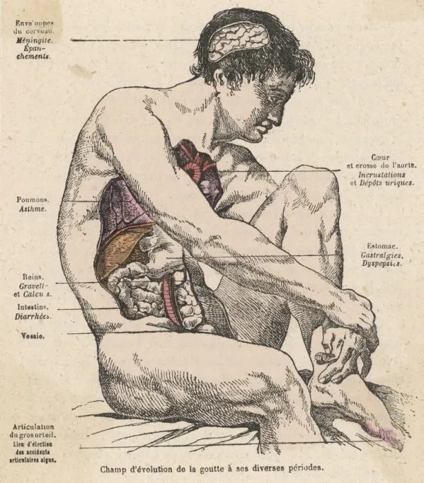 Framed Print : GOUT. Diagram to show how various parts of the body are affected by the Framed Print : GOUT. Diagram to show how various parts of the body are affected by the