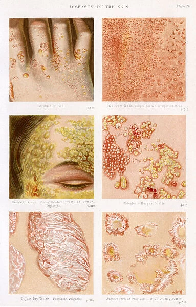 Diseases of the Skin - Plate 5