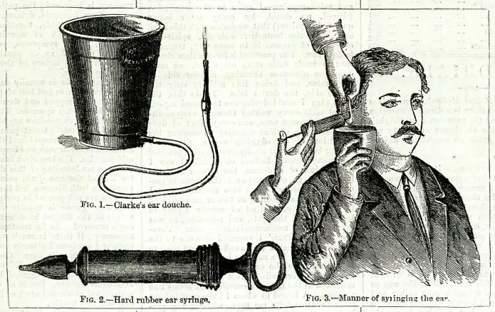 Framed Print : Doctor syringing a patient's ear Framed Print : Doctor syringing a patient's ear