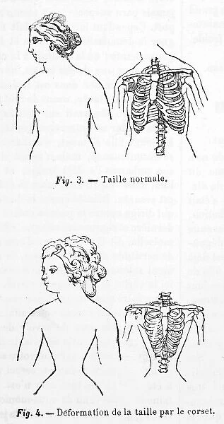 Effect of Corsets