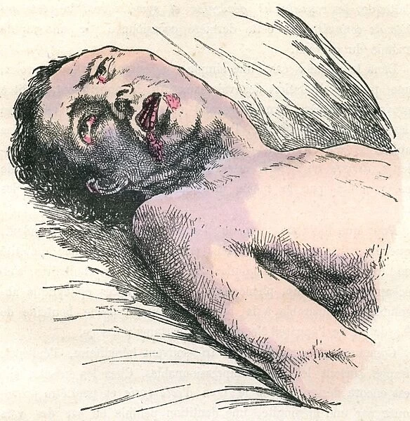 EPILEPSY. Diagram to show an unconscious victim of a strong epilectic attack Date: 1883