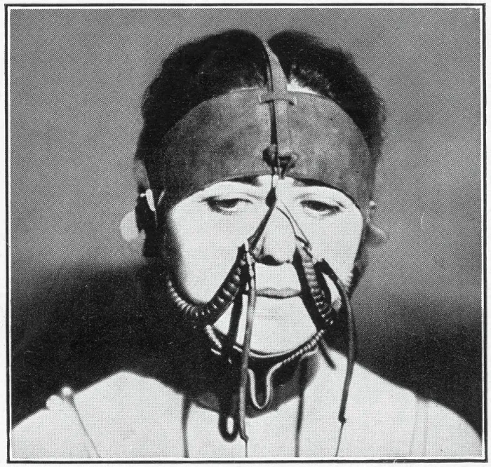 Framed Print : Extreme process of beauty in the parlour of Mme Lina Cavalieri. Woman changing her nasal contours using electrical apparatus strapped around her face, all in the name of fashion. Date: 1927 Framed Print : Extreme process of beauty in the parlour of Mme Lina Cavalieri. Woman changing her nasal contours using electrical apparatus strapped around her face, all in the name of fashion. Date: 1927