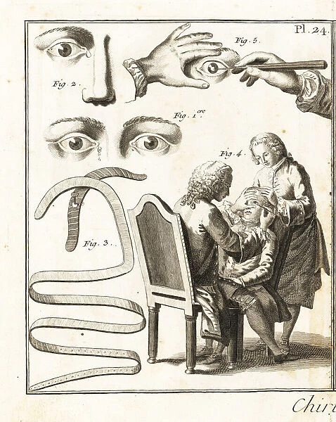 Eye surgery, 18th century