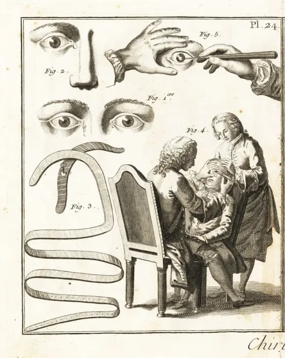 Framed Print : Eye surgery, 18th century Framed Print : Eye surgery, 18th century