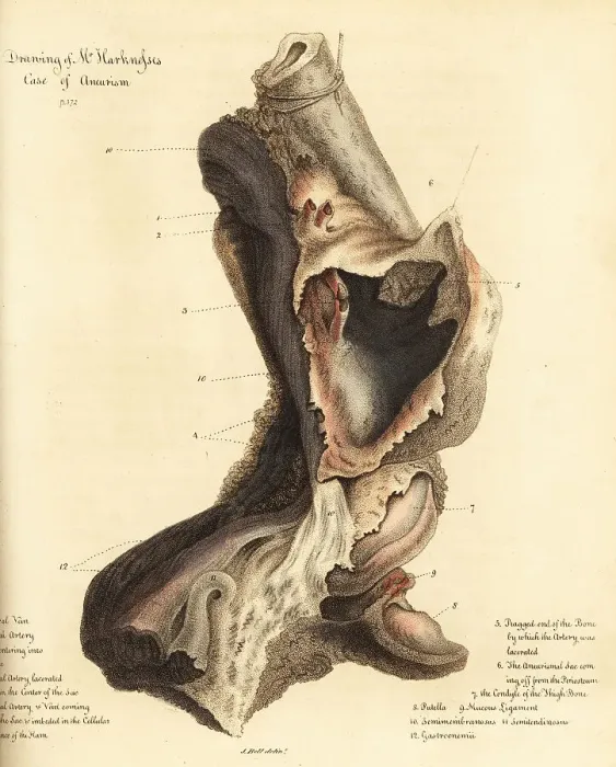 Framed Print : Fatal aneurysmal sac from the broken leg of a man, 1815 Framed Print : Fatal aneurysmal sac from the broken leg of a man, 1815