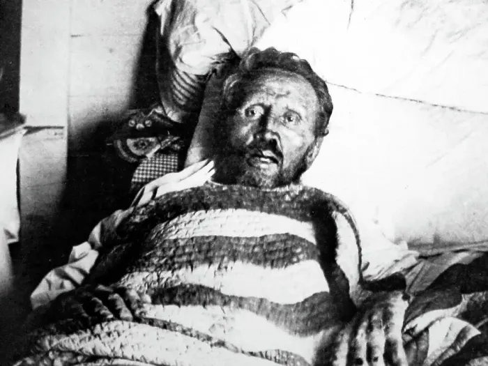 Framed Print : Father Damien on his death bed in 1889 Framed Print : Father Damien on his death bed in 1889