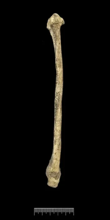 Framed Print : Fibula of Achondroplastic Dwarf Framed Print : Fibula of Achondroplastic Dwarf