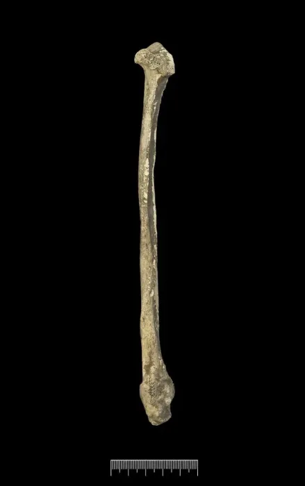 Framed Print : Fibula of Achondroplastic Dwarf Framed Print : Fibula of Achondroplastic Dwarf