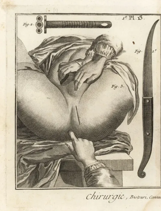 Framed Print : Fouberts surgical operation to remove a bladder stone Framed Print : Fouberts surgical operation to remove a bladder stone