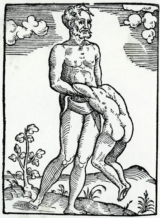 Framed Print : FREAK BIRTH / TWIN / 1560 Framed Print : FREAK BIRTH / TWIN / 1560