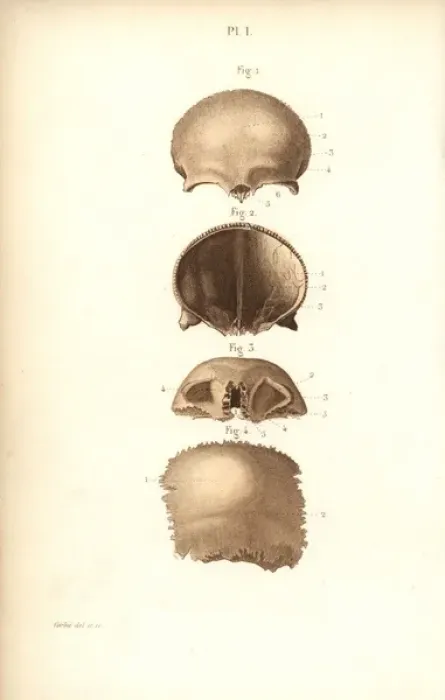 Framed Print : Frontal bones of the skull Framed Print : Frontal bones of the skull