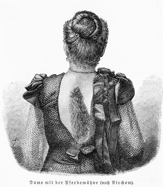 Hair on Back. A lady with an abnormal growth of hair on her back Date: late 19th century