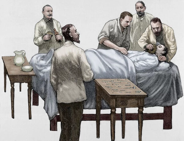 History of medicine. Chloroform anesthesia. Engraving, 19th