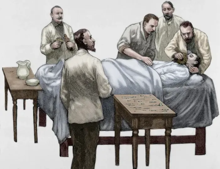 Framed Print : History of medicine. Chloroform anesthesia. Engraving, 19th Framed Print : History of medicine. Chloroform anesthesia. Engraving, 19th