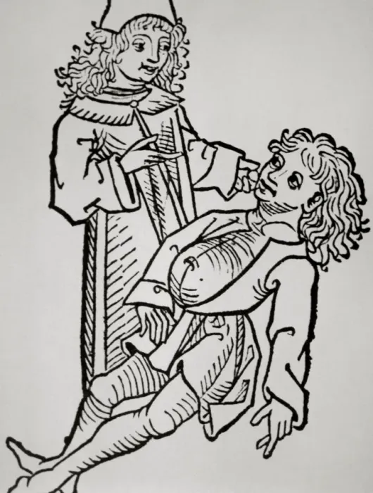 Framed Print : History of medicine. Modern Age. Belly infaldo. Cirrhosis. W Framed Print : History of medicine. Modern Age. Belly infaldo. Cirrhosis. W