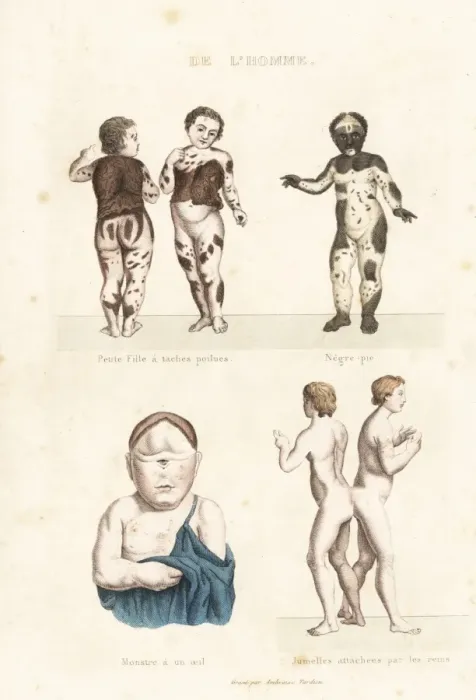 Framed Print : Human disorders Framed Print : Human disorders