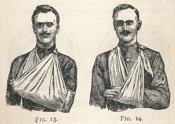 Illustrations of large and small arm slings