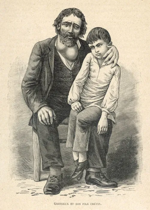Framed Print : MAN WITH GOITRE AND SON Framed Print : MAN WITH GOITRE AND SON