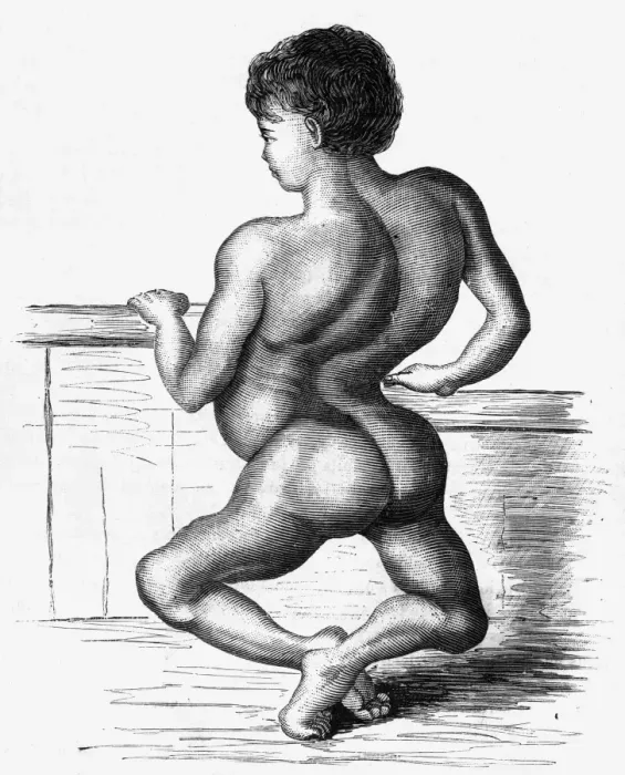 Framed Print : Medical / Ailments / Rickets Framed Print : Medical / Ailments / Rickets