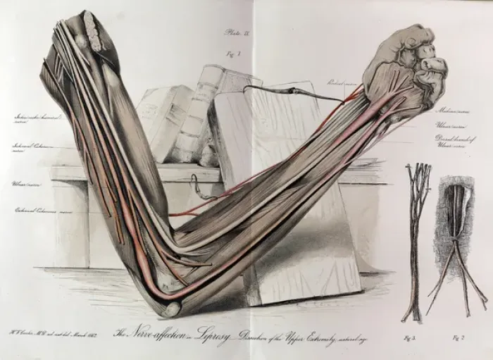 Framed Print : The nerves of the arm in Leprosy Framed Print : The nerves of the arm in Leprosy