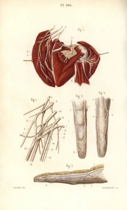 Framed Print : Nerves to the brachial plexus and the finger Framed Print : Nerves to the brachial plexus and the finger
