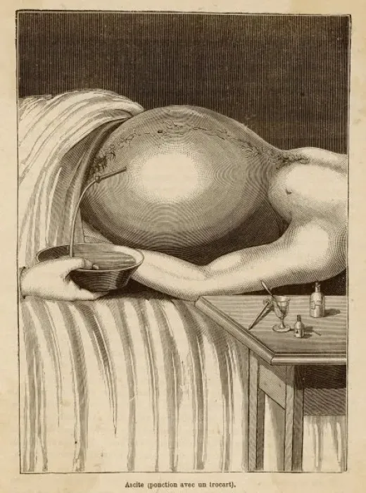 Framed Print : Removal of Fluid Framed Print : Removal of Fluid