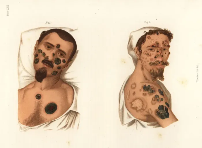 Framed Print : Secondary period syphilis symptoms on the body Framed Print : Secondary period syphilis symptoms on the body