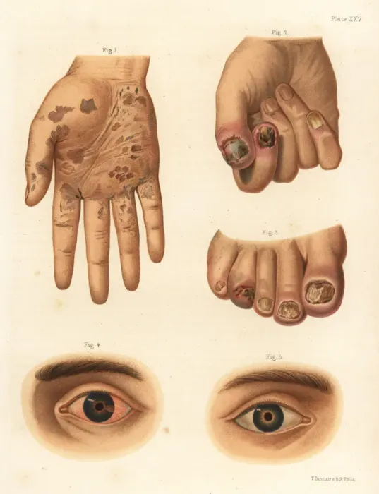 Framed Print : Secondary period syphilis symptoms on the body Framed Print : Secondary period syphilis symptoms on the body