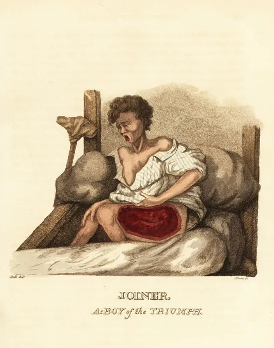 Framed Print : A ship's boy with a case of necrotizing fasciitis Framed Print : A ship's boy with a case of necrotizing fasciitis