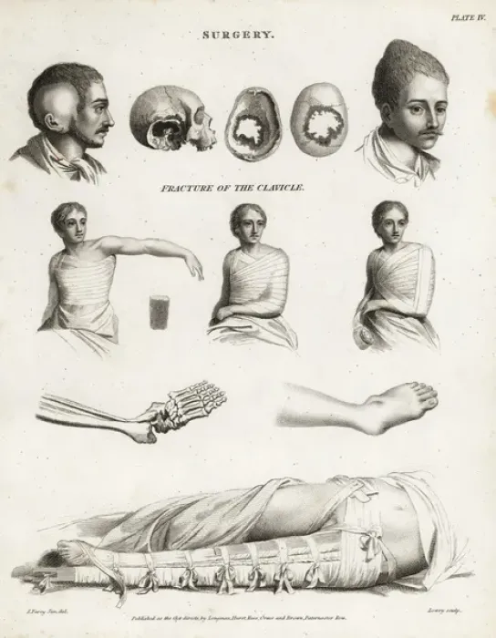 Framed Print : Surgical procedures from the 19th century Framed Print : Surgical procedures from the 19th century