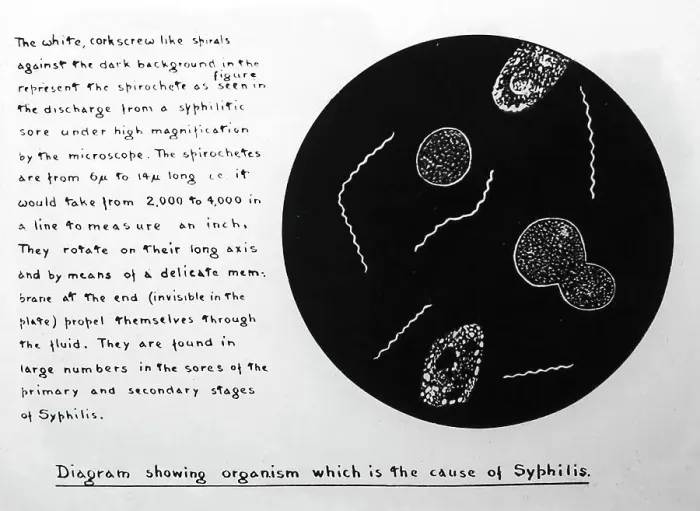Framed Print : The Syphilis organism, 1920s projection slide Framed Print : The Syphilis organism, 1920s projection slide