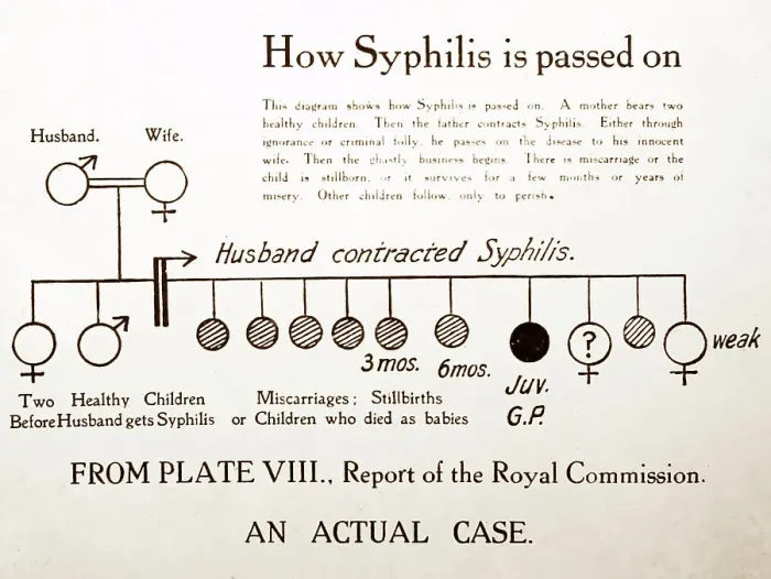 Framed Print : How syphilis is passed on, 1920s projection slide Framed Print : How syphilis is passed on, 1920s projection slide