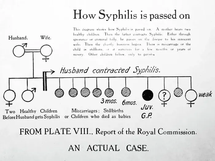 Framed Print : How syphilis is passed on, 1920s projection slide Framed Print : How syphilis is passed on, 1920s projection slide
