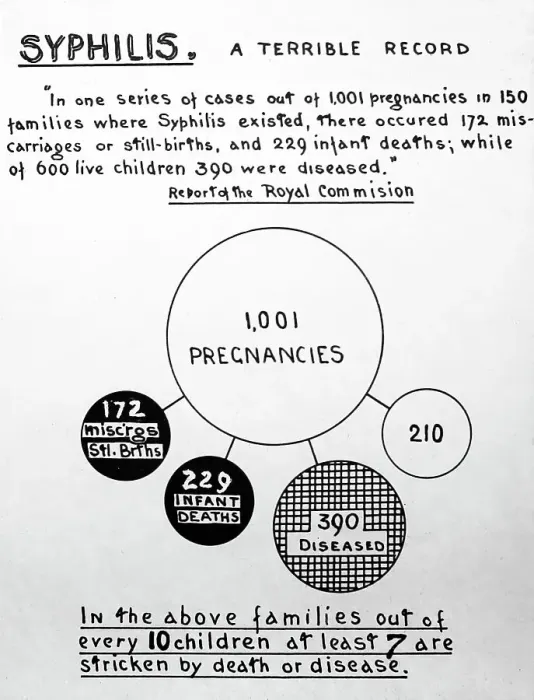 Framed Print : Syphilis and pregnancy, 1920s projection slide Framed Print : Syphilis and pregnancy, 1920s projection slide