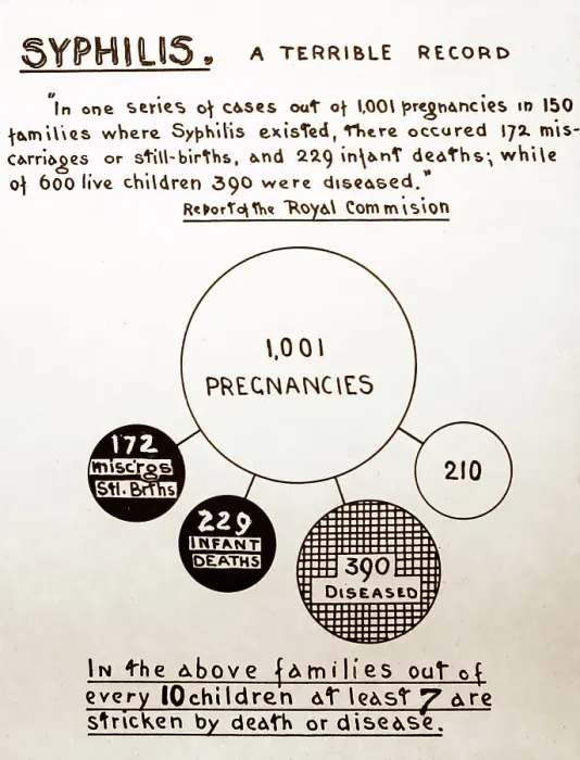 Framed Print : Syphilis and pregnancy, 1920s projection slide Framed Print : Syphilis and pregnancy, 1920s projection slide