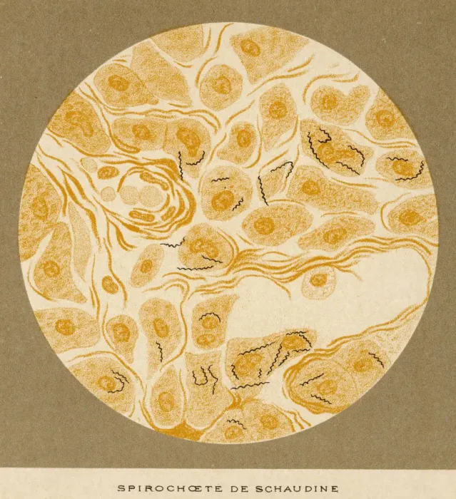 Framed Print : Syphilis Spirochaete Framed Print : Syphilis Spirochaete