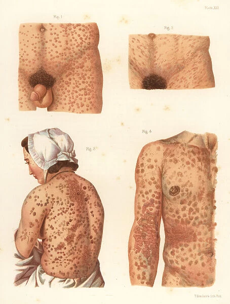 Syphilis symptoms on the body
