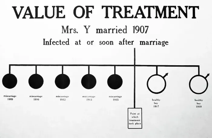Framed Print : Syphilis treatment, 1920s projection slide Framed Print : Syphilis treatment, 1920s projection slide