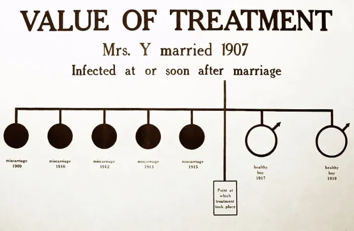 Framed Print : Syphilis treatment, 1920s projection slide Framed Print : Syphilis treatment, 1920s projection slide