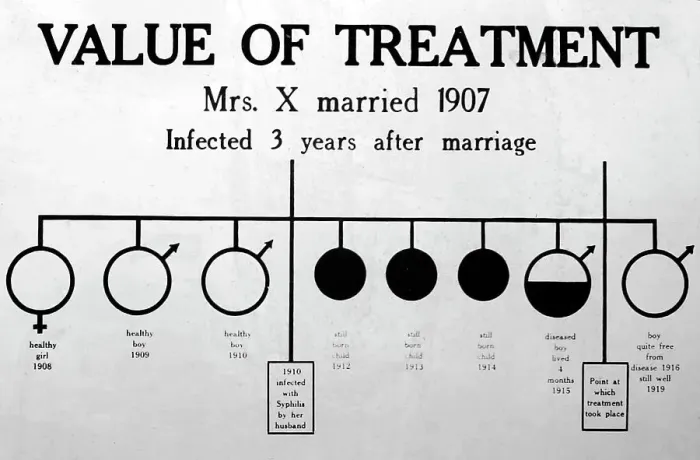 Framed Print : Syphilis treatment, 1920s projection slide Framed Print : Syphilis treatment, 1920s projection slide