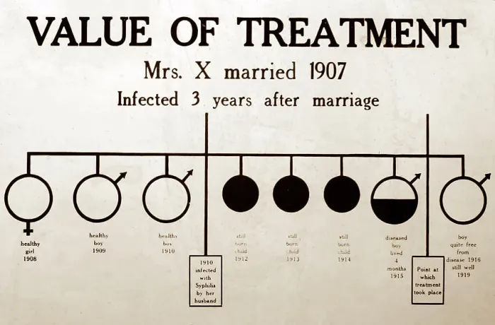 Framed Print : Syphilis treatment, 1920s projection slide Framed Print : Syphilis treatment, 1920s projection slide