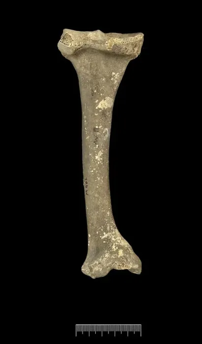 Framed Print : Tibia of Achondroplastic Dwarf Framed Print : Tibia of Achondroplastic Dwarf