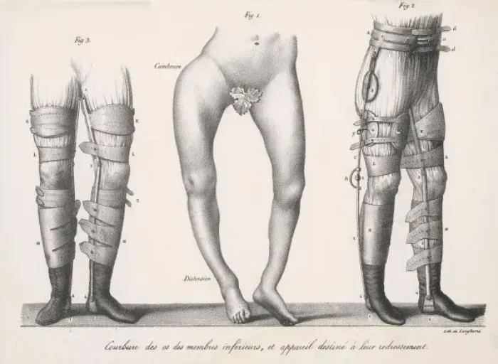 Framed Print : Treating Bow Legs (2) Framed Print : Treating Bow Legs (2)