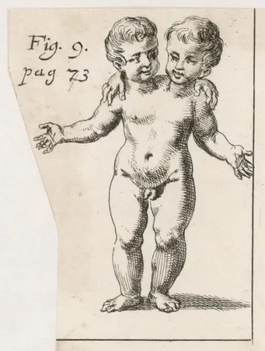 Framed Print : Two-Headed Child / 1691 Framed Print : Two-Headed Child / 1691