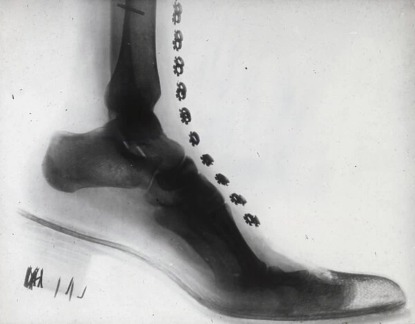 X-Ray - Human Foot