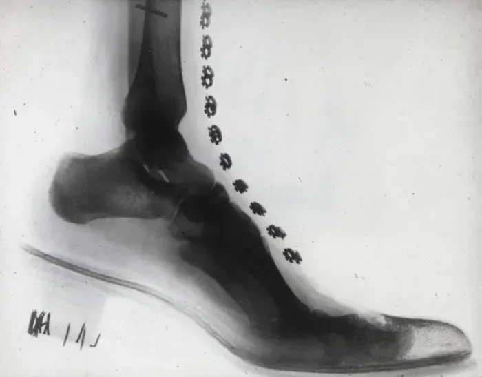 Framed Print : X-Ray - Human Foot Framed Print : X-Ray - Human Foot