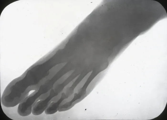 Framed Print : X-Ray - Human Foot Framed Print : X-Ray - Human Foot